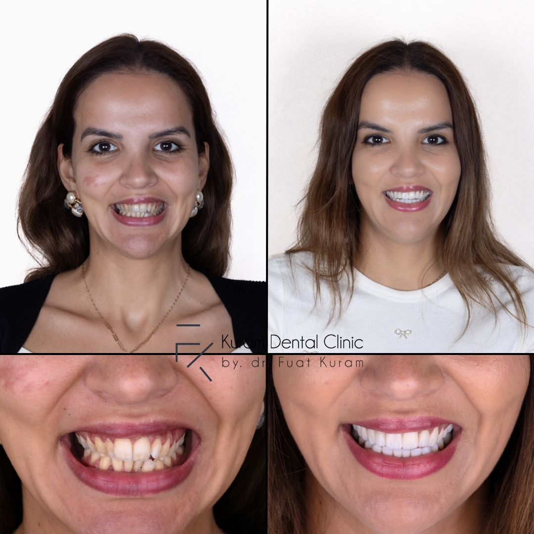 Antalya Dental Implant Treatment