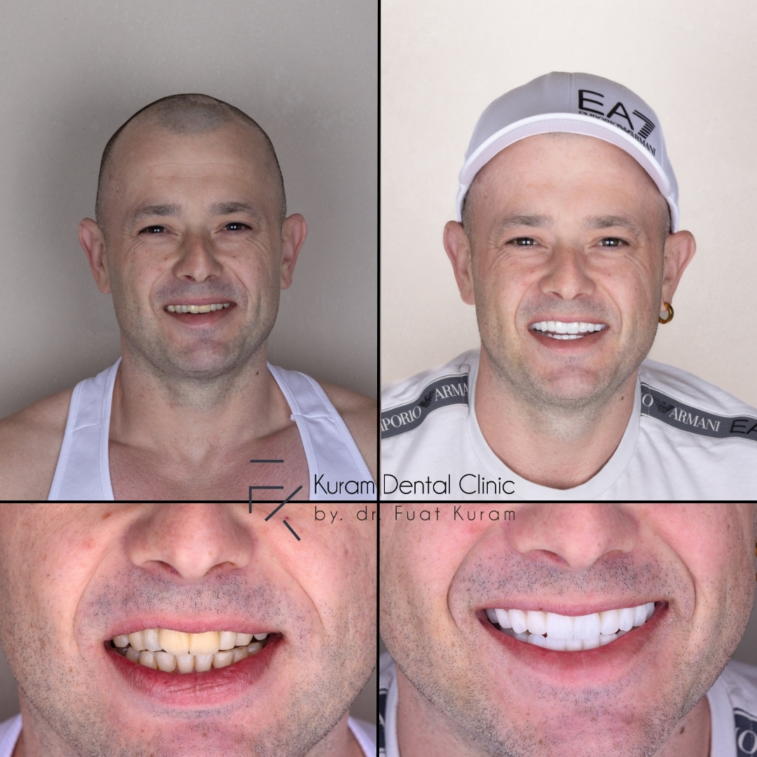 Turkey Best Dental Clinic