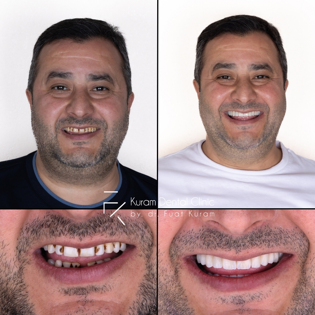 Turkey Dental Implant Treatment