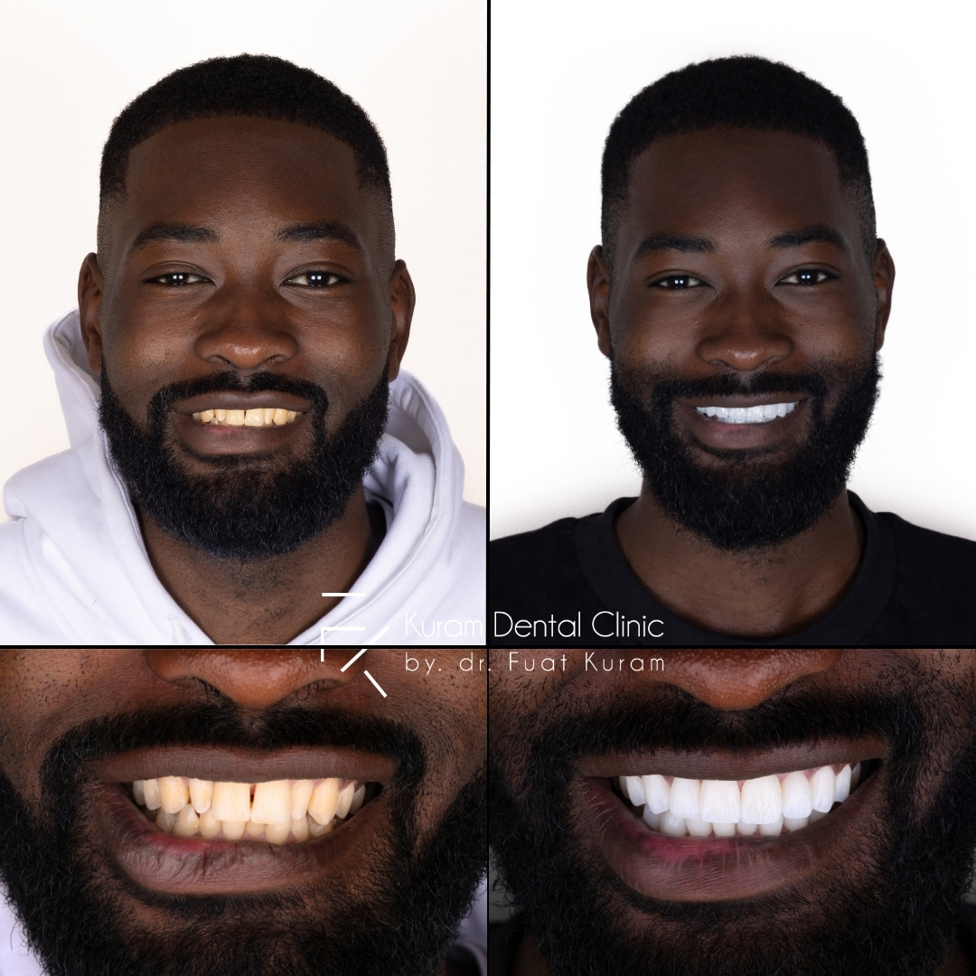 Turkey Dental Implant Treatment