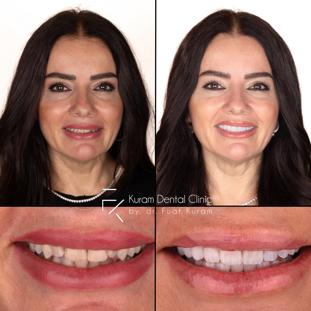 Antalya All on 4 Implant Treatment