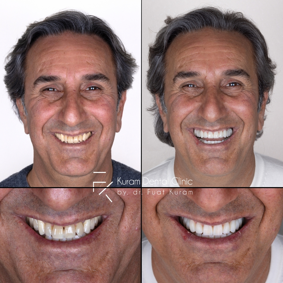 Turkey Dental Implant Treatment