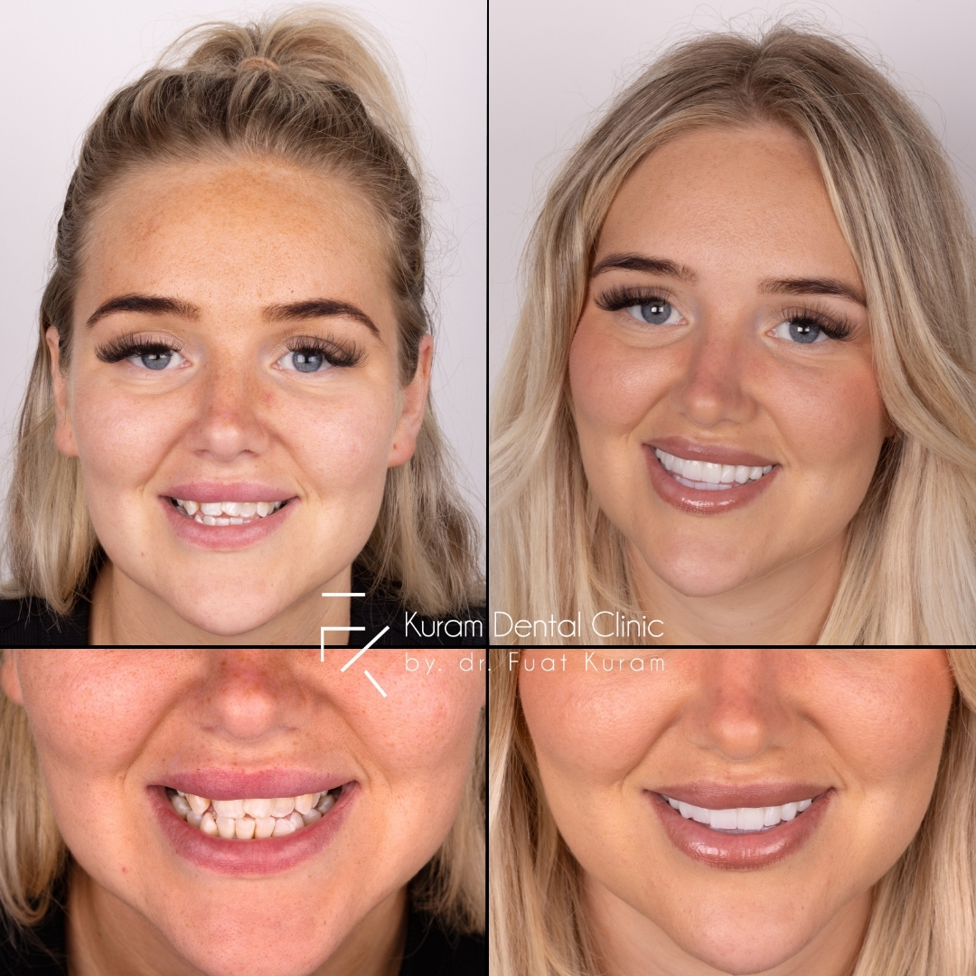 Turkey Dental Implant Treatment