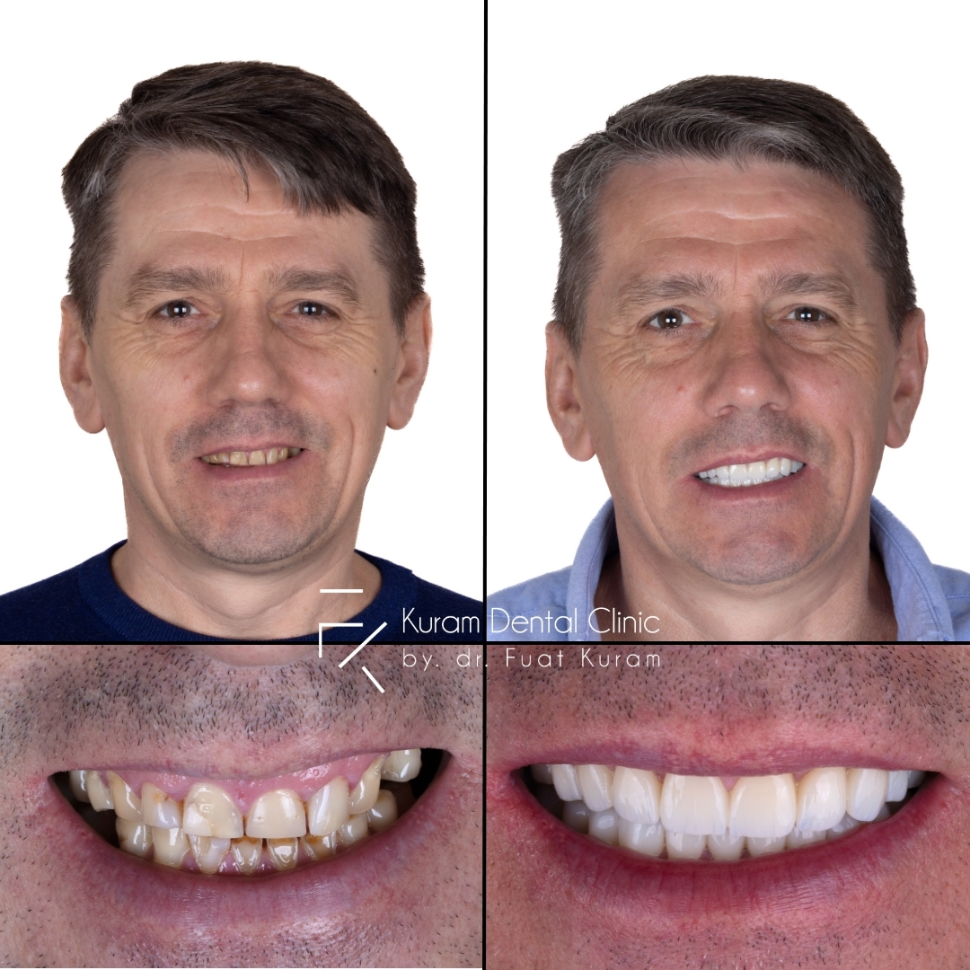 Turkey Dental Implant Treatment