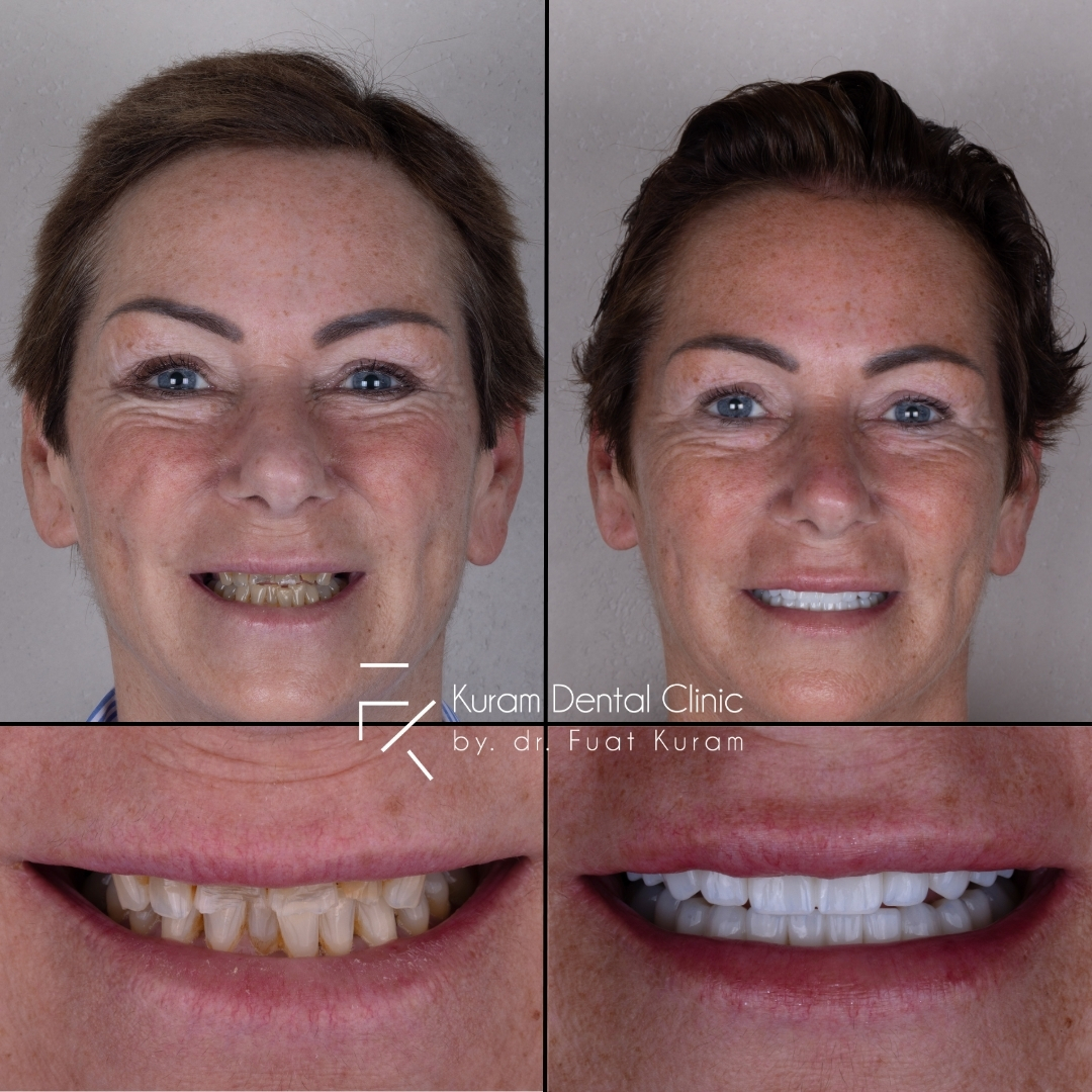 Turkey Dental Implant Treatment