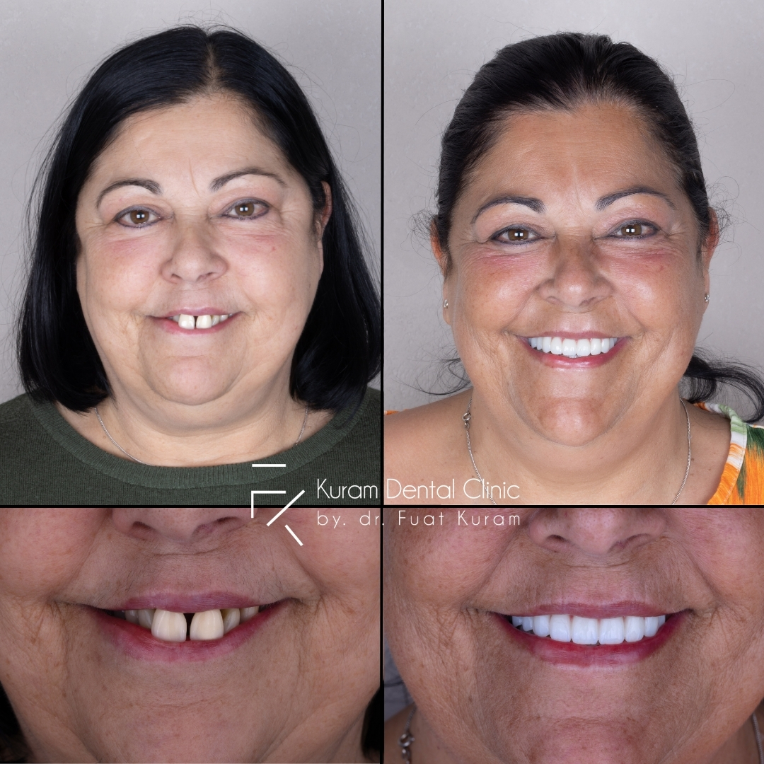 Turkey Dental Implant Treatment