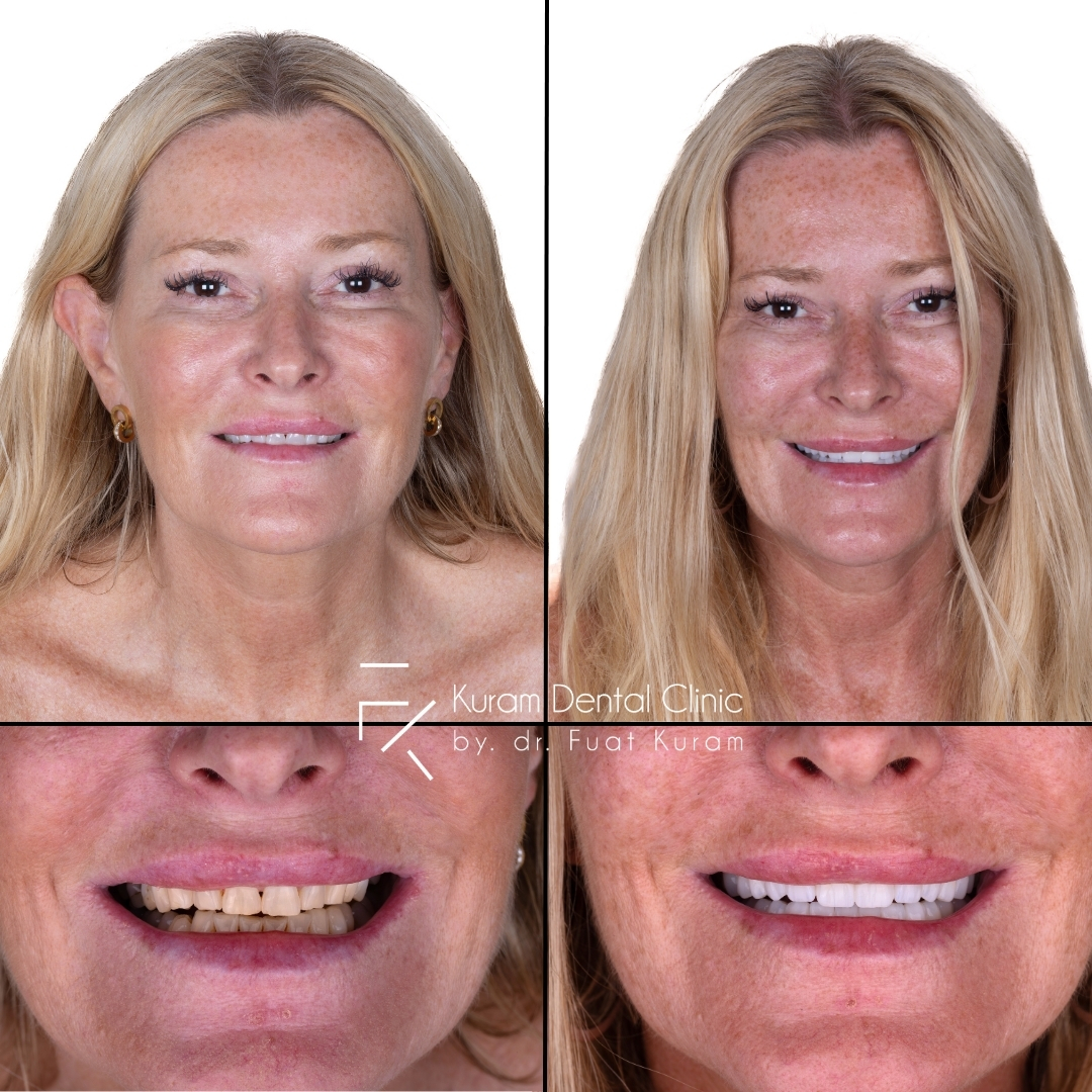 Turkey Dental Implant Treatment
