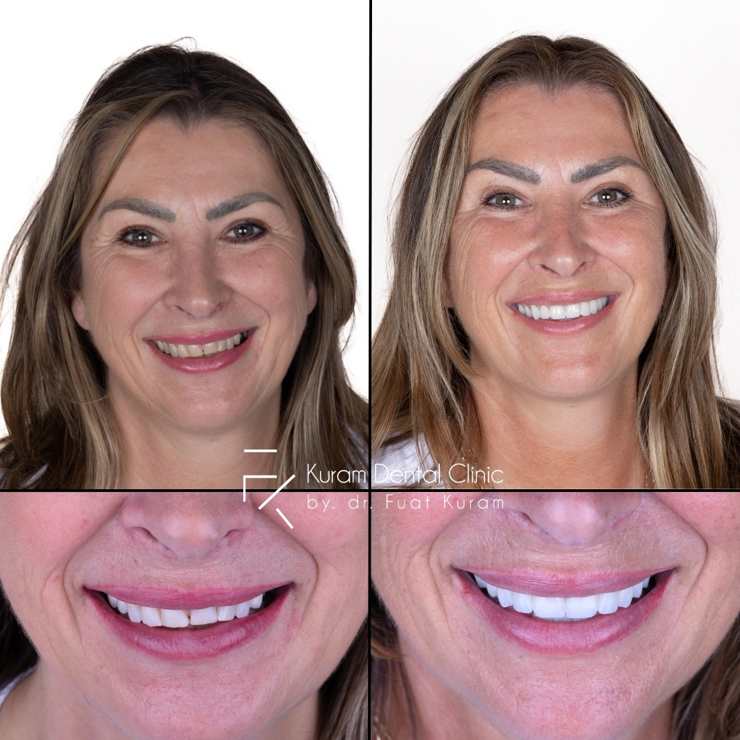 Turkey Dental Implant Treatment