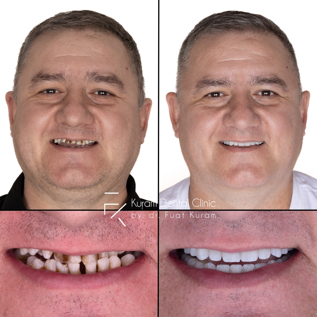 Turkey Dental Implant Treatment