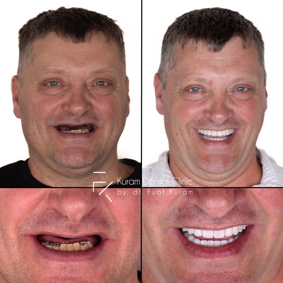 Turkey Dental Implant Treatment
