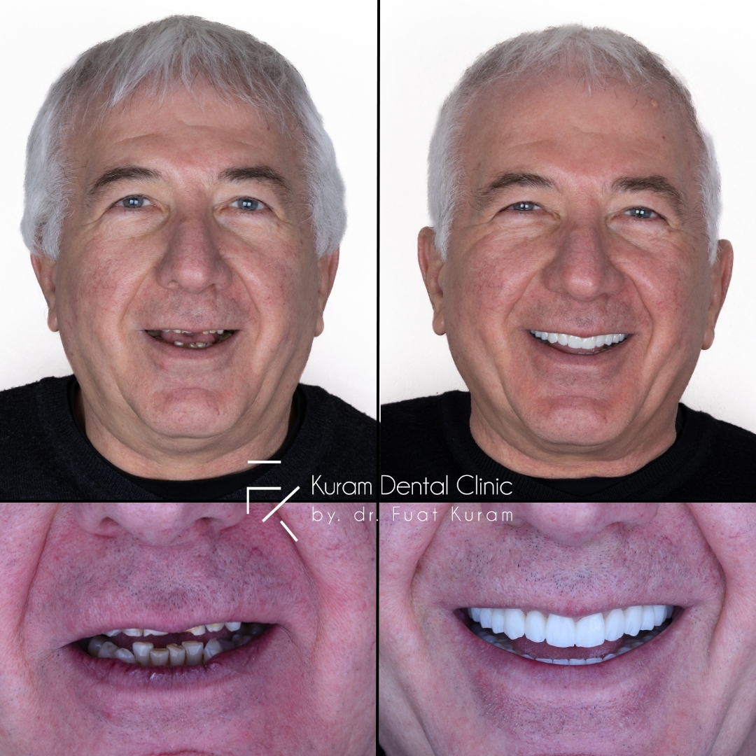 Antalya All on 6 Implant Treatment