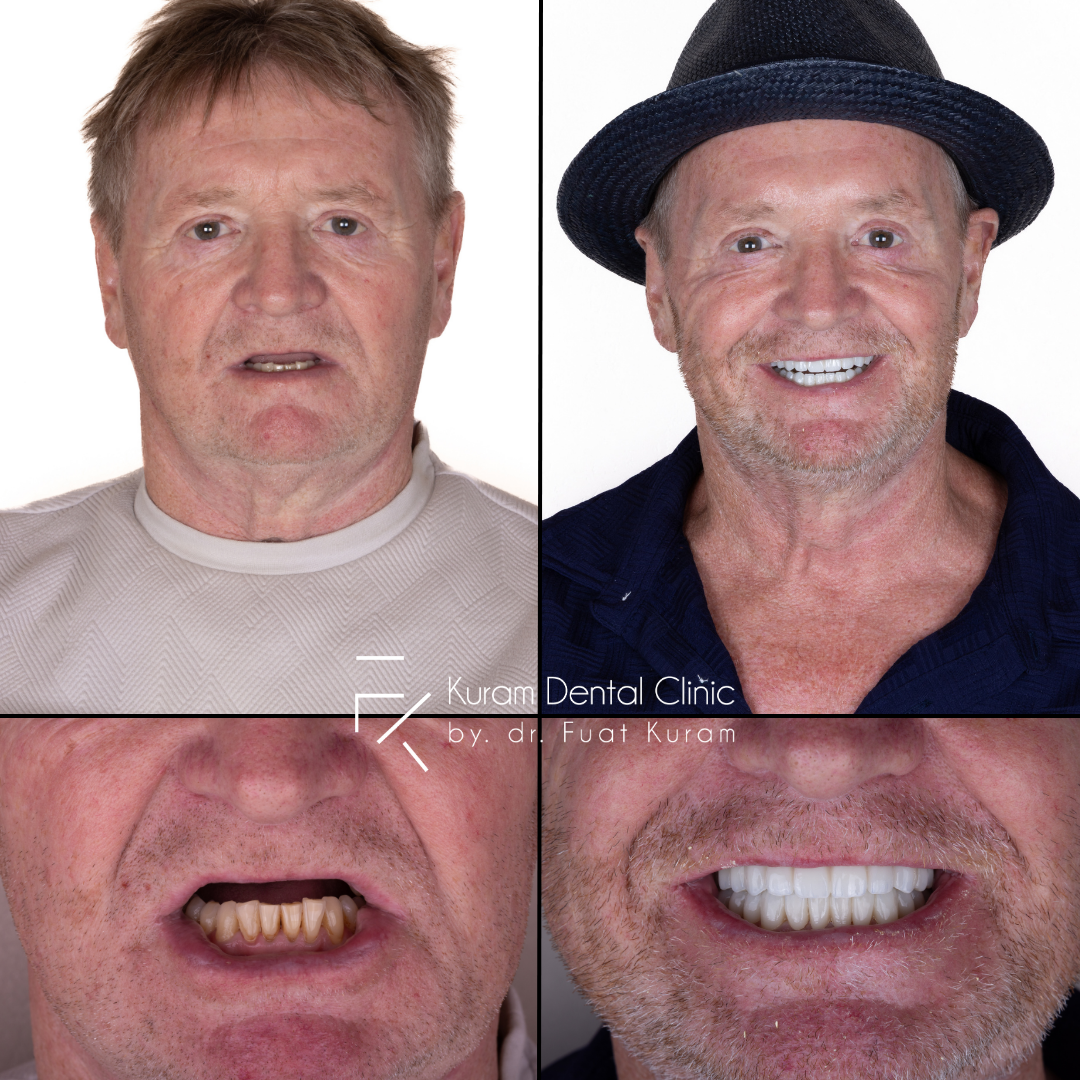 Antalya Dental Implant Treatment