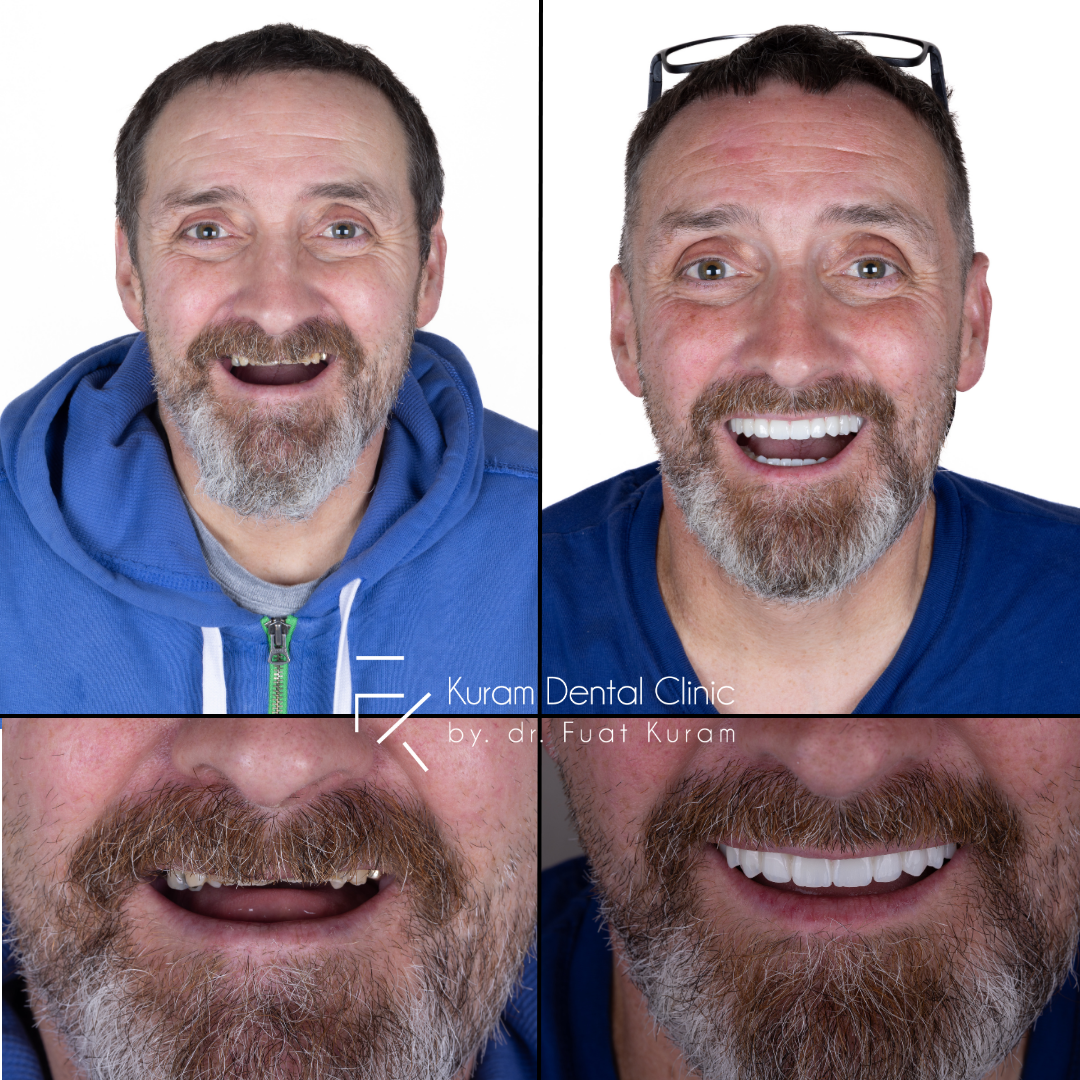 Antalya Dental Implant Treatment