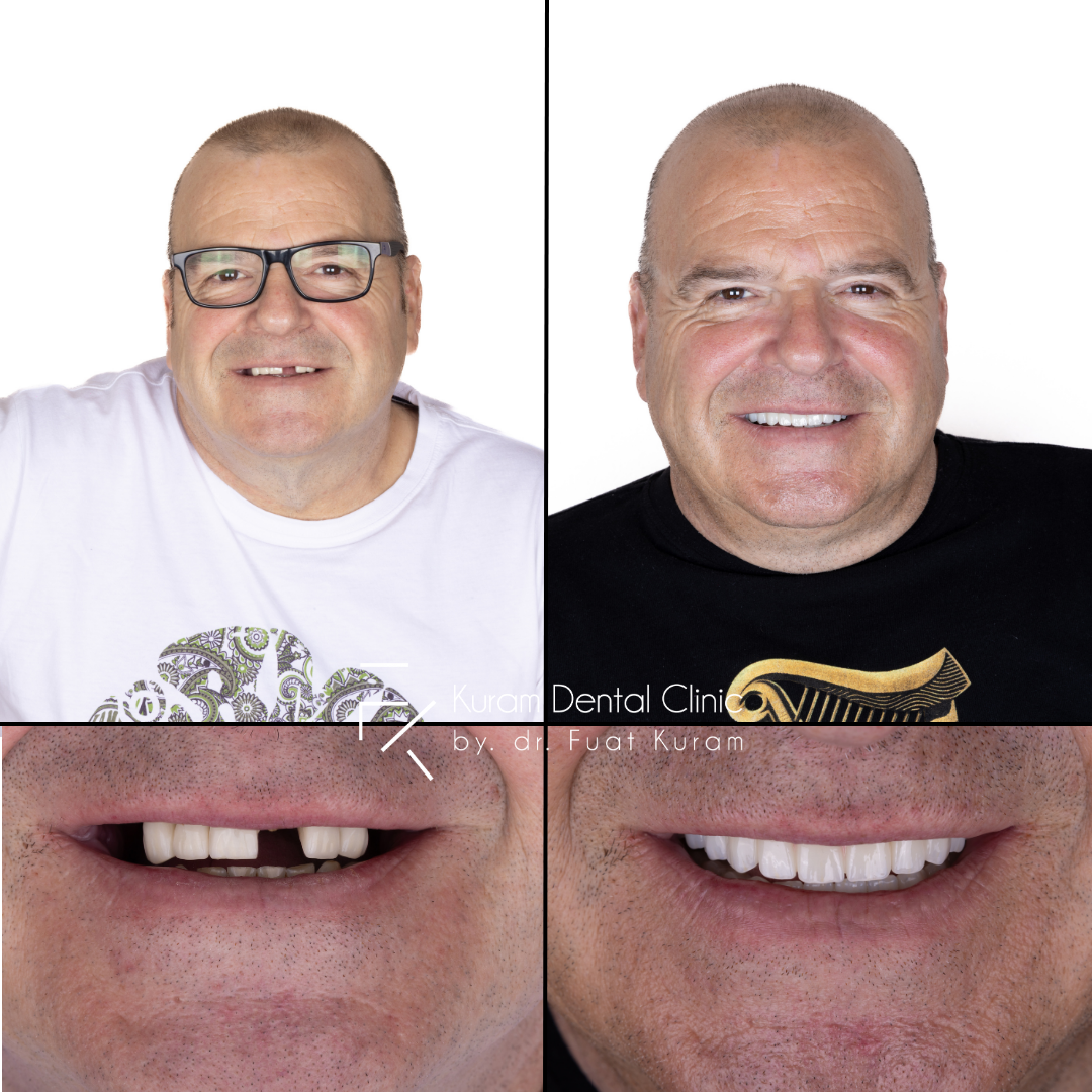 Antalya All on 4 Implant Treatment