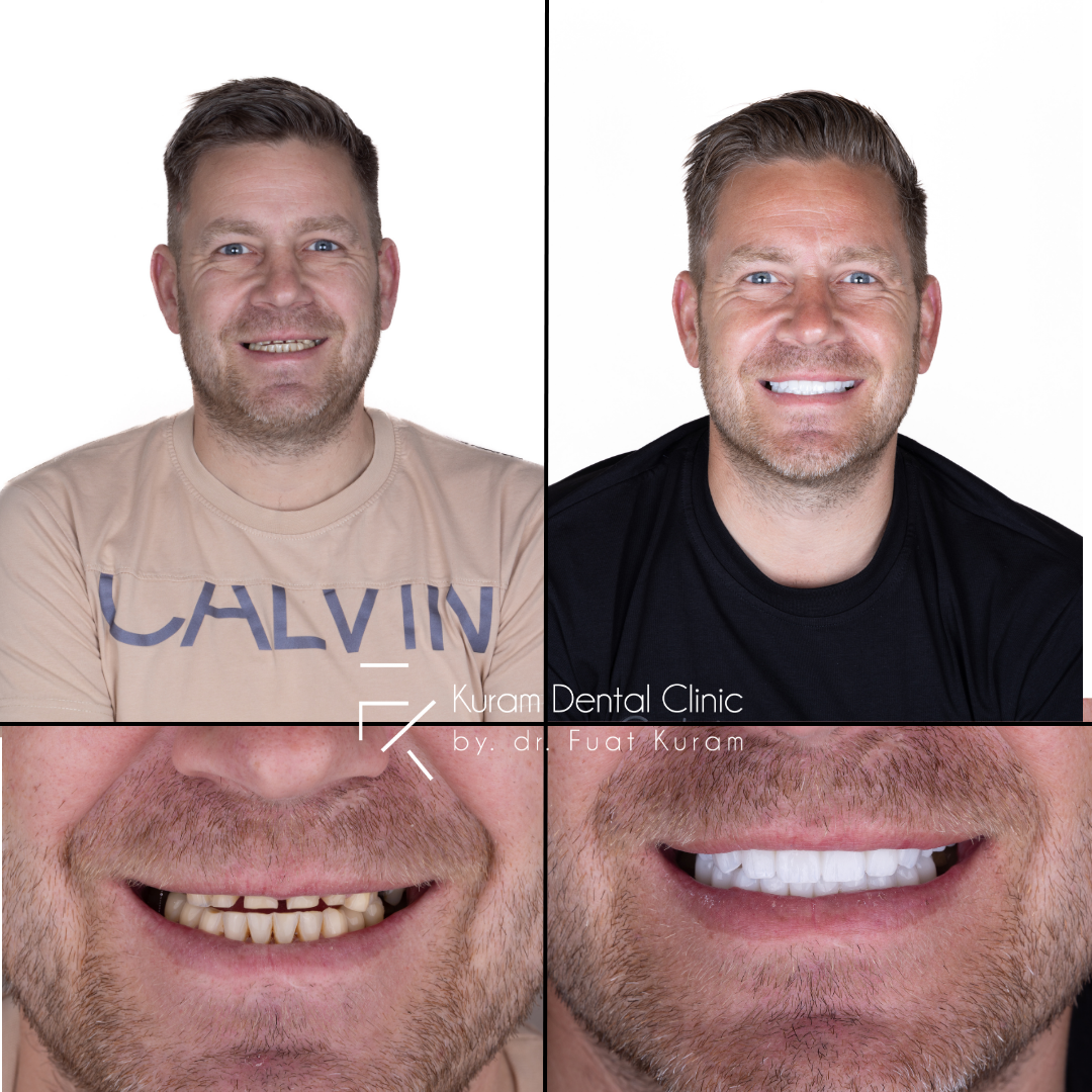 Antalya All on 6 Implant Treatment