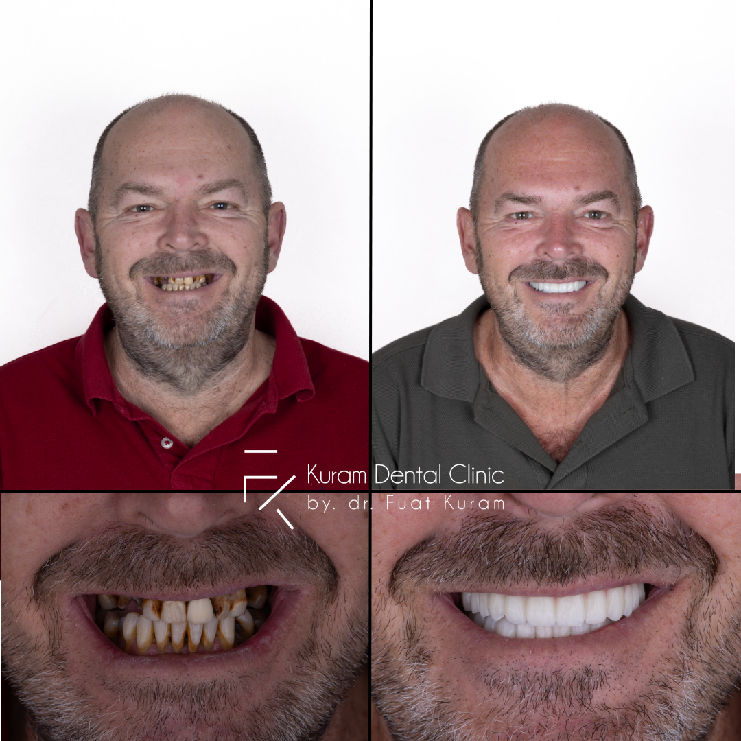 Antalya Hollywood Smile Design Treatment