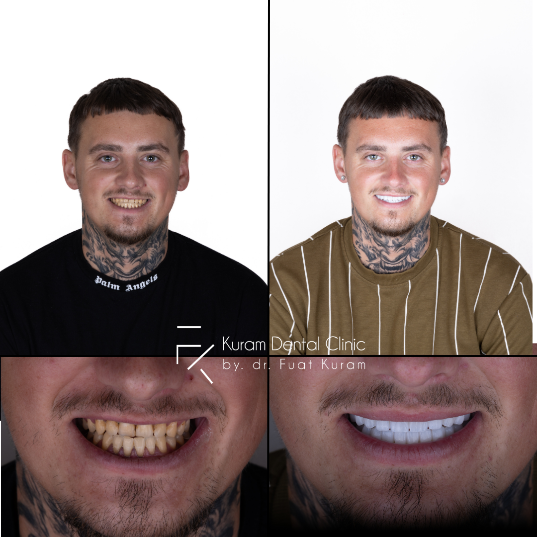 Turkey Dental Implant Treatment