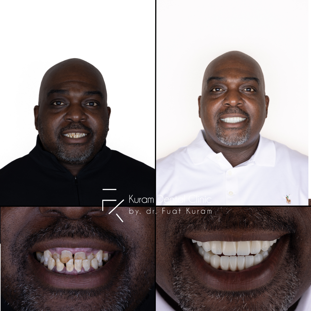 Turkey Dental Implant Treatment