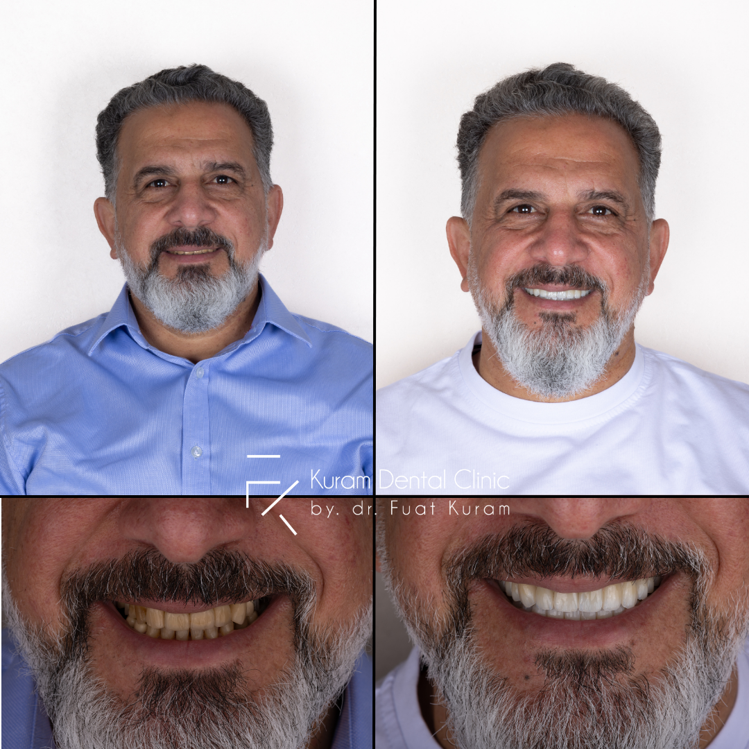 Turkey All on 6 Implant Treatment