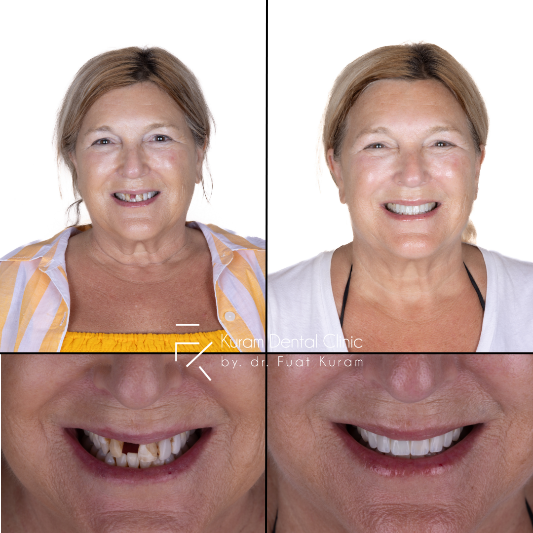 Turkey Dental Treatment