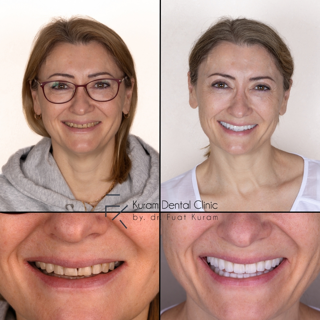 Antalya Hollywood Smile Design Treatment