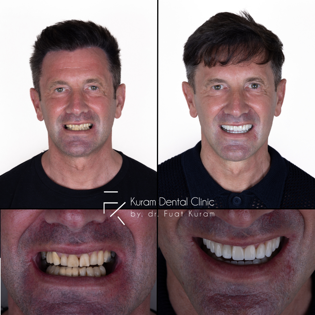 Turkey Dental Implant Treatment