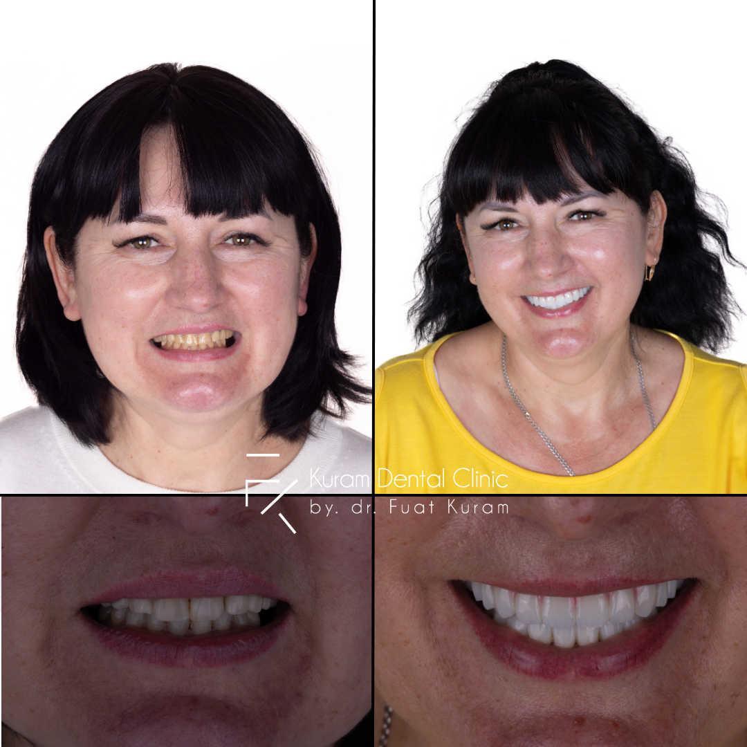 Antalya Dental Treatment