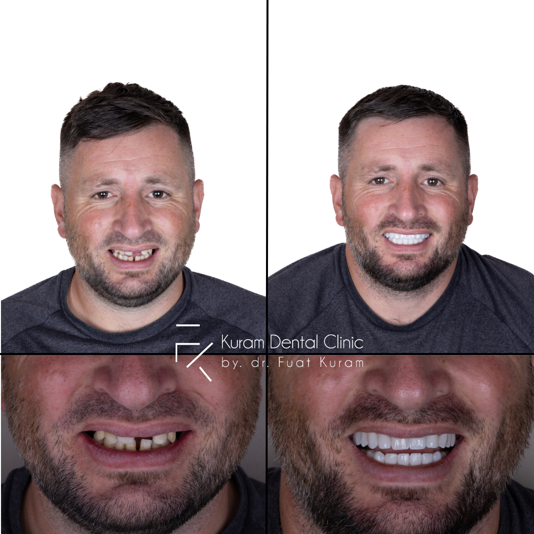 All on Four Treatment Antalya