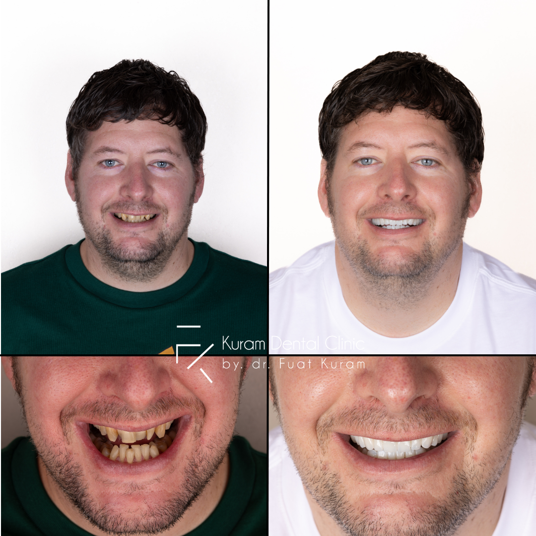 All on Four Treatment Turkey