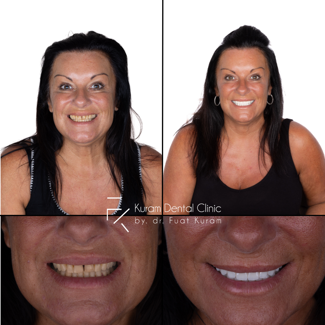 Turkey Dental Implant Treatment