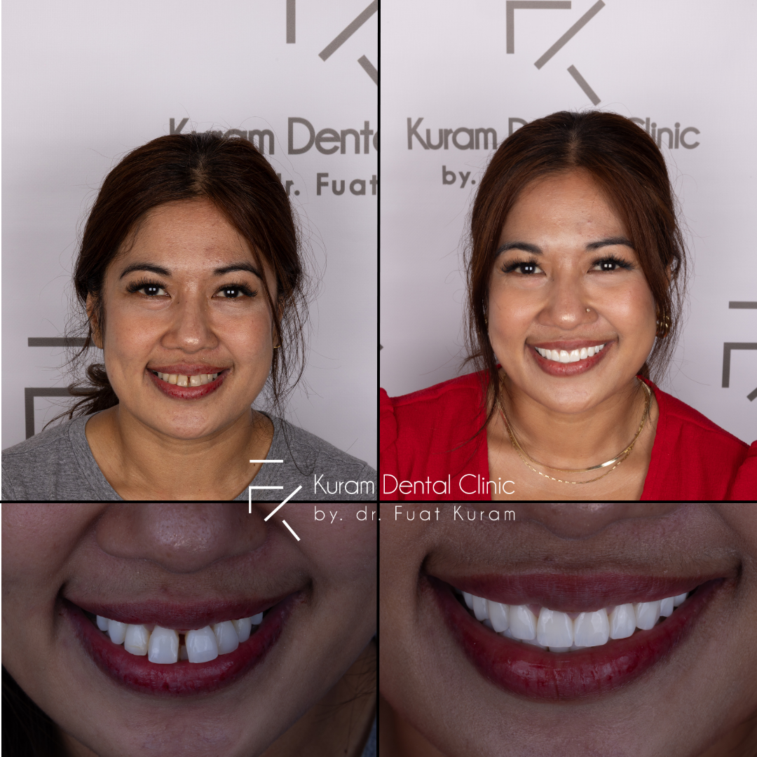 All on Six Treatment Antalya