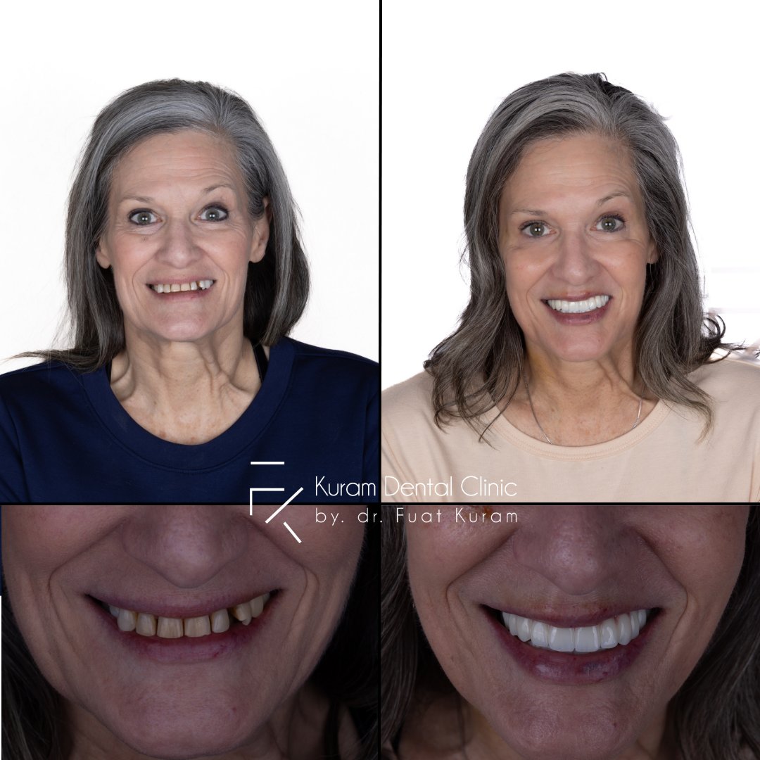 All on Six Treatment Turkey