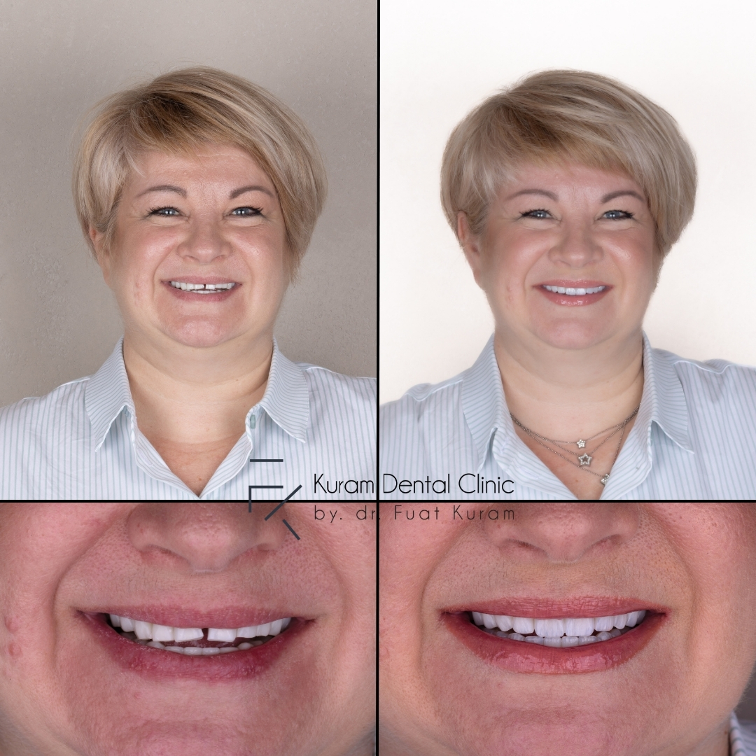 Turkey Dental Implant Treatment