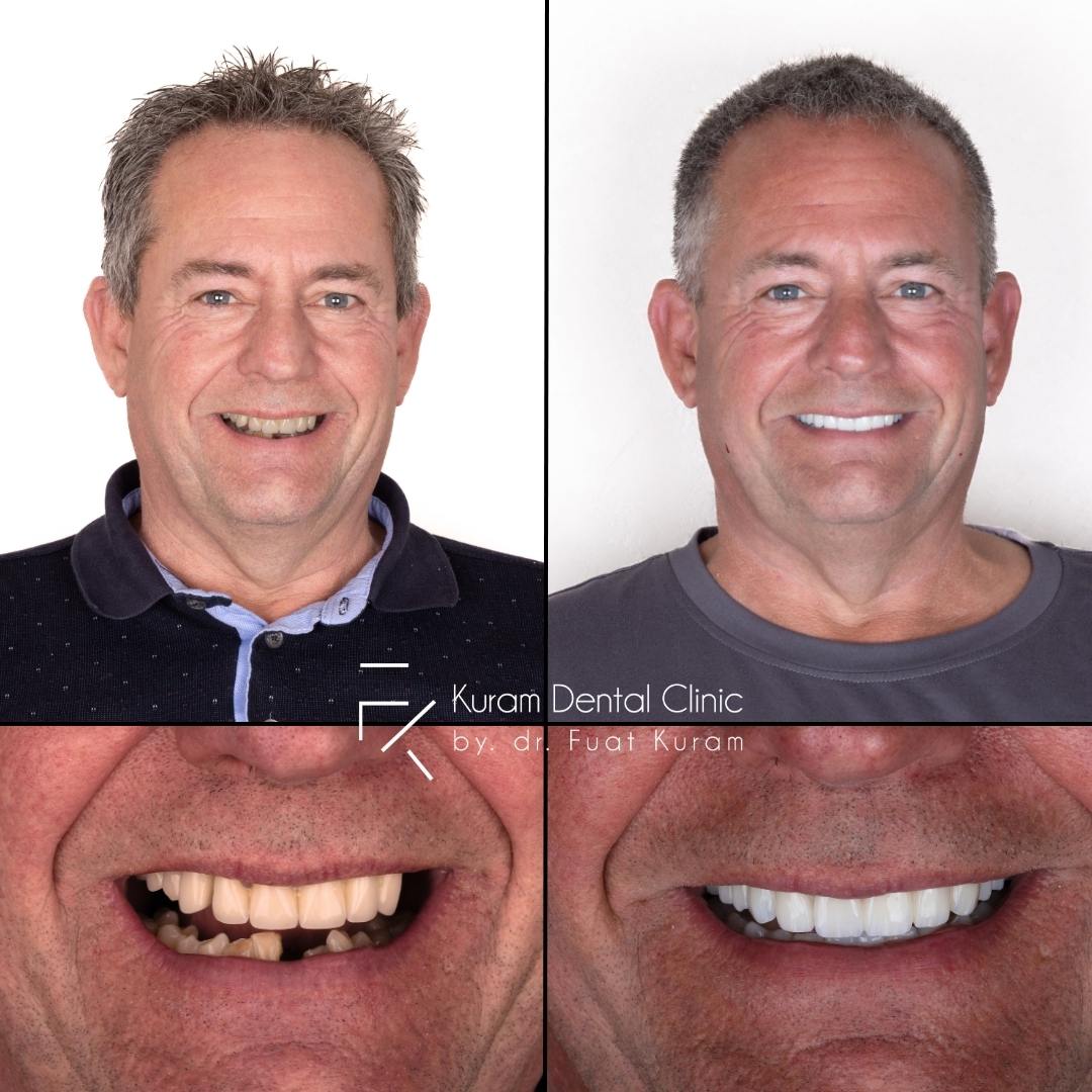 Turkey All on 4 Implant Treatment