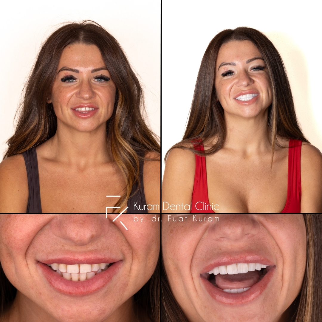 Turkey All on 6 Implant Treatment