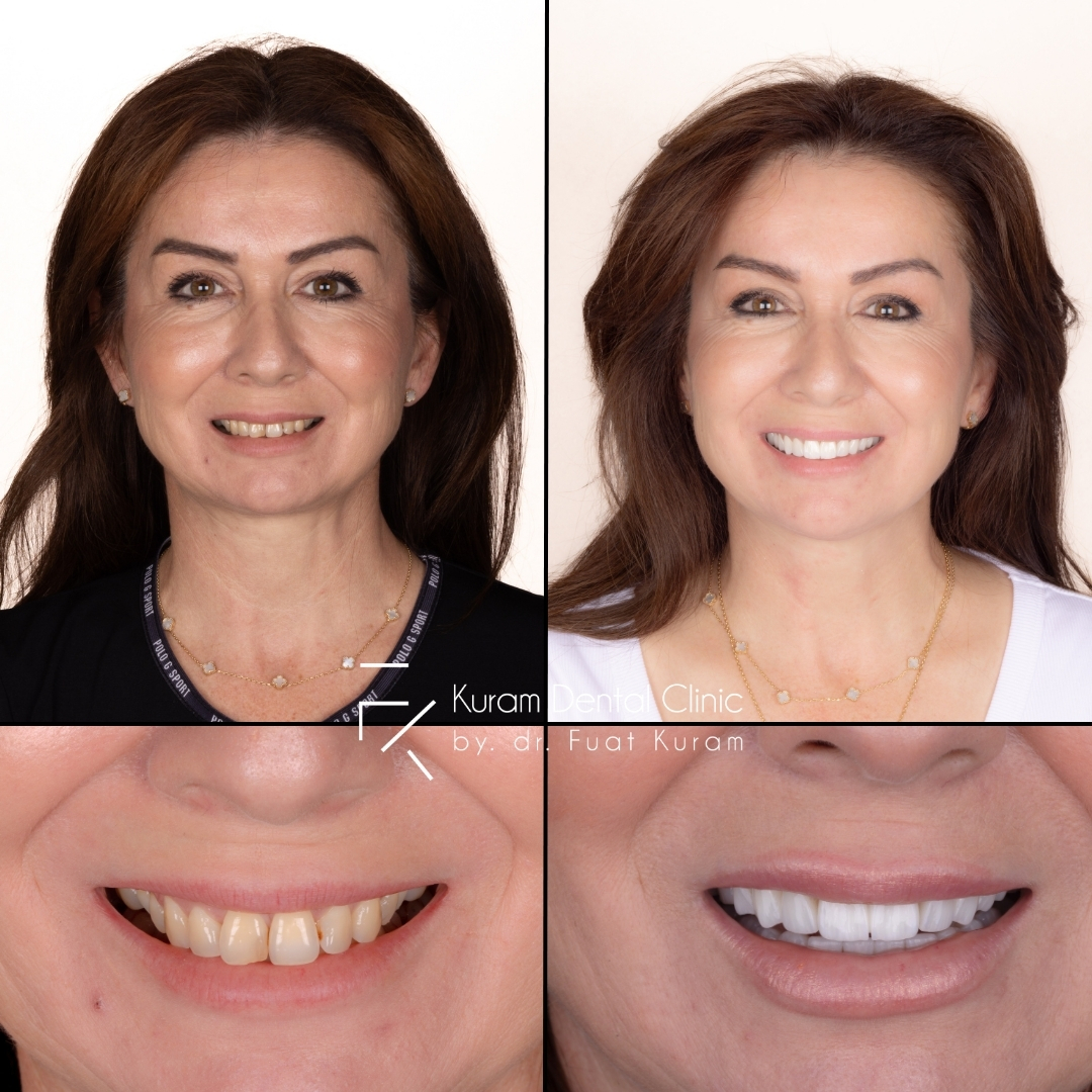Turkey Dental Treatment