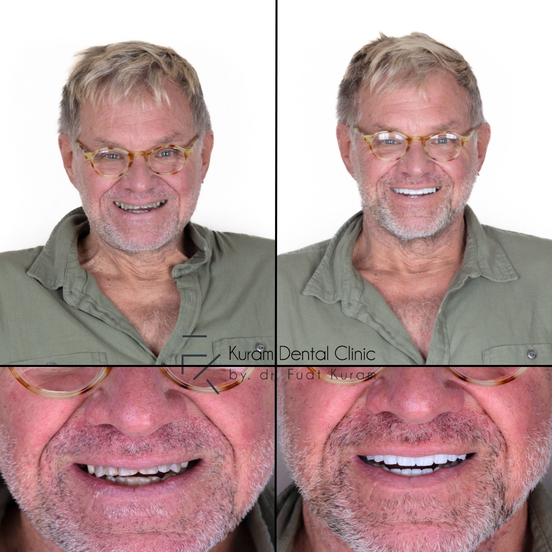 Antalya Dental Treatment