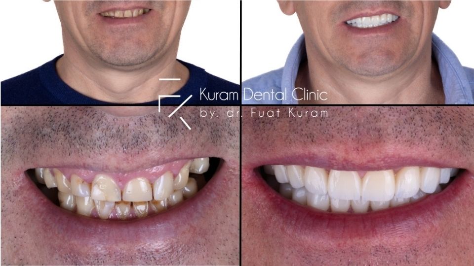 Is A1 tooth shade suitable for everyone?