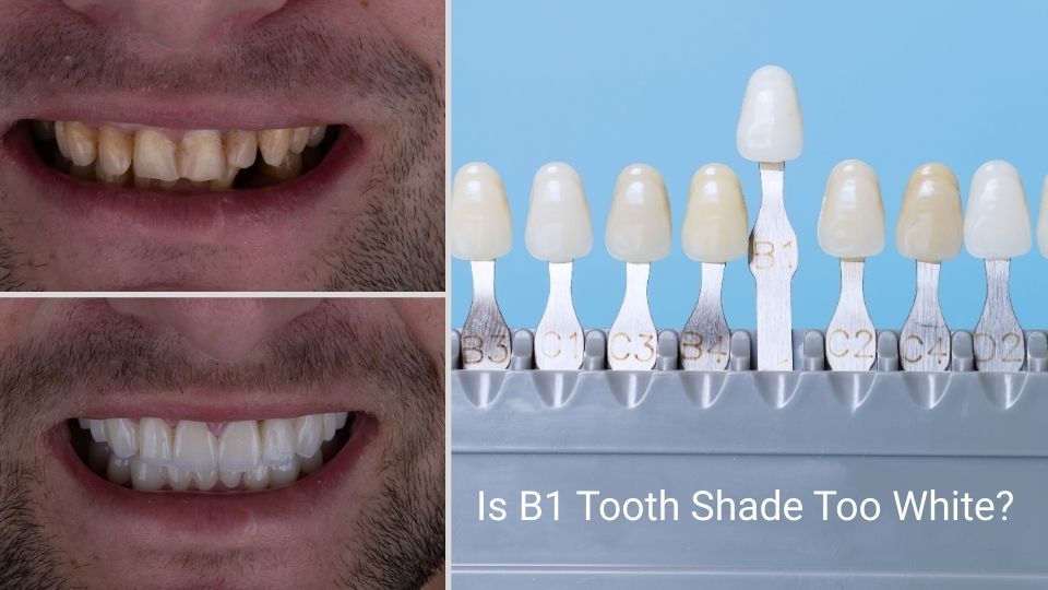 Is the B1 Tooth Shade Too White or Naturally
