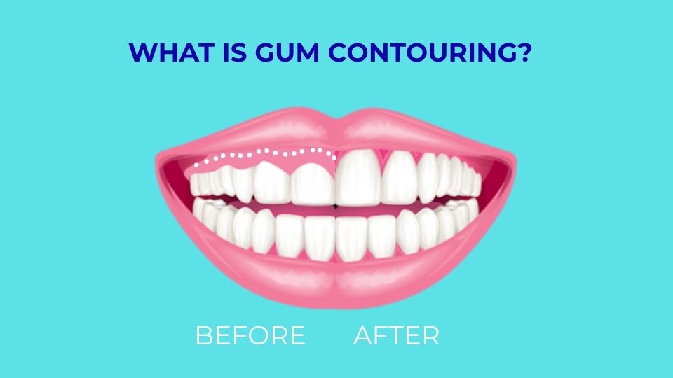 Gum Contouring Before-After