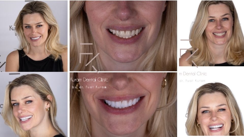 Hollywood Smile Antalya Hollywood Smile Antalya