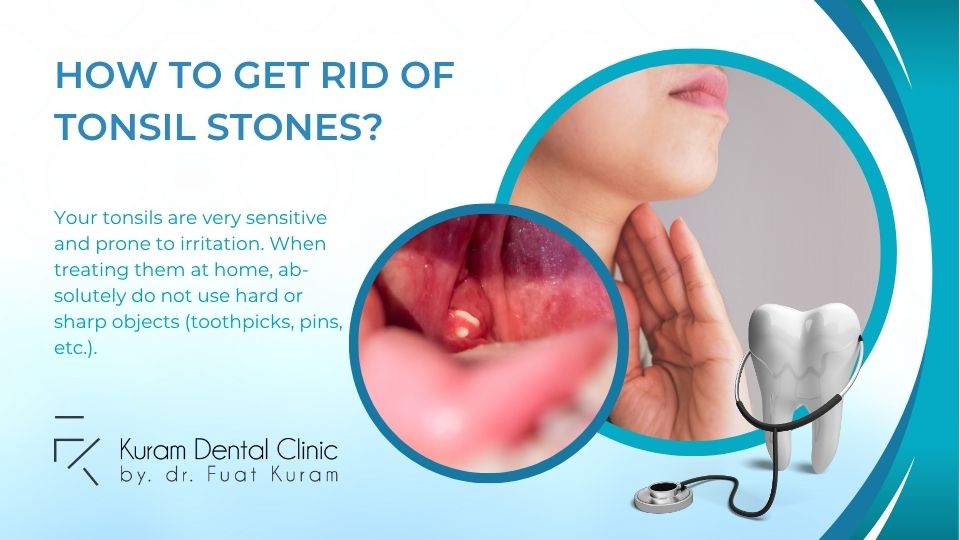 How to Get Rid of Tonsil Stone