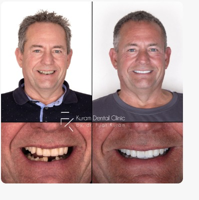 Antalya Dental Implant Treatment