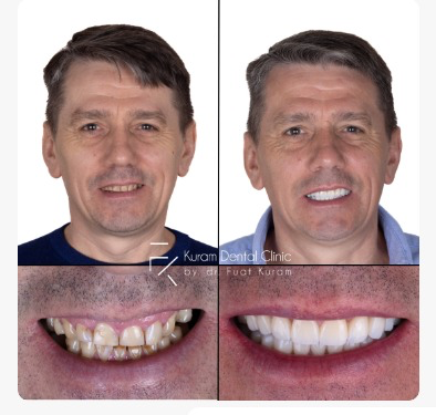 Antalya All on 4 Implant Treatment