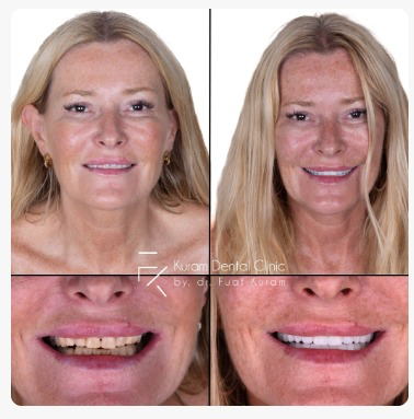 Turkey Dental Implant Treatment