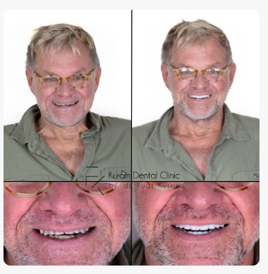 Turkey All on 4 Implant Treatment