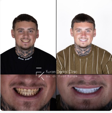 Turkey All on 6 Implant Treatment