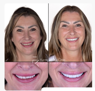 Turkey Dental Treatment